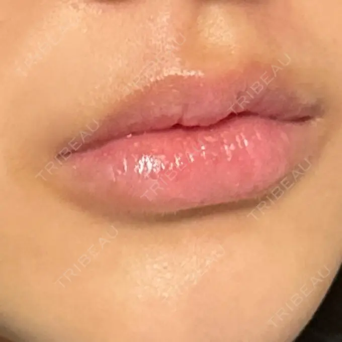 ヒアルロン酸注入（唇） / ボトックス（口角） ルラ美容クリニック 高田馬場院 DAY 19 メイン用