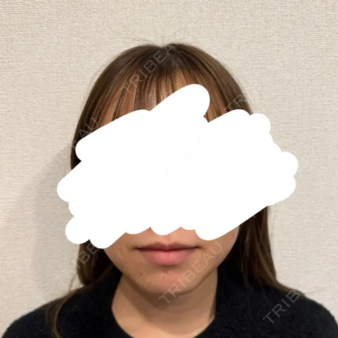 脂肪吸引（顔） Mods Clinic（モッズクリニック） 名古屋院 DAY 21 メイン用