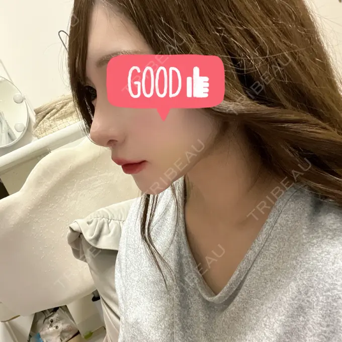 鼻尖形成（切開） / 鼻中隔延長（切開） / 軟骨移植 / 骨切幅寄せ / ワシ鼻修正・ハンプ切除 / 鼻修正 札幌ル・トロワ ビューティクリニックVogue AFTER メイン用