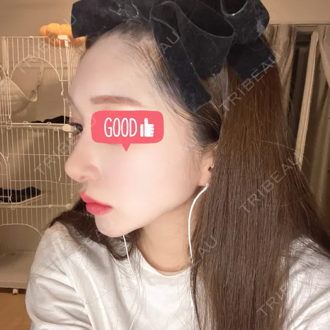 鼻尖形成（切開） / 鼻中隔延長（切開） / 軟骨移植 / 骨切幅寄せ / ワシ鼻修正・ハンプ切除 / 鼻修正 札幌ル・トロワ ビューティクリニックVogue DAY 30 メイン用