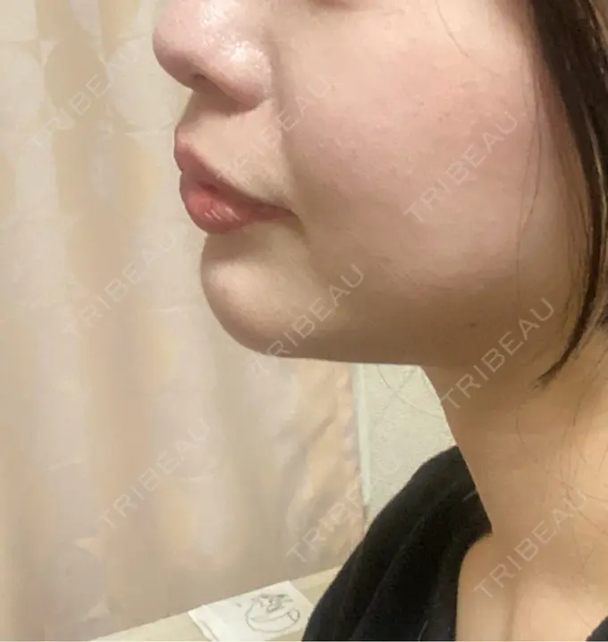 ヒアルロン酸注入（あご） ファイヤークリニック 名古屋院 AFTER メイン用