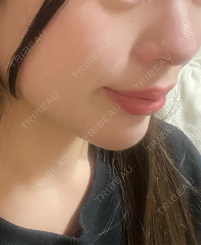 ヒアルロン酸注入（あご） ファイヤークリニック 名古屋院 DAY 2 メイン用