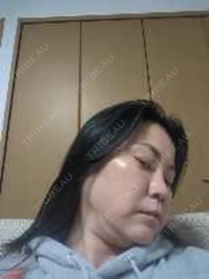 ボトックス（エラ・小顔） / 高濃度ビタミンC点滴 TCB東京中央美容外科 松山院 DAY 0 メイン用