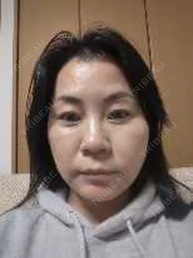 ボトックス（エラ・小顔） / 高濃度ビタミンC点滴 TCB東京中央美容外科 松山院 DAY 0 メイン用