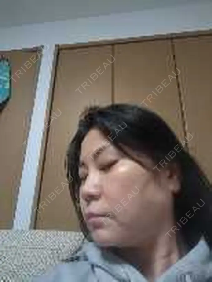 ボトックス（エラ・小顔） / 高濃度ビタミンC点滴 TCB東京中央美容外科 松山院 DAY 0 メイン用