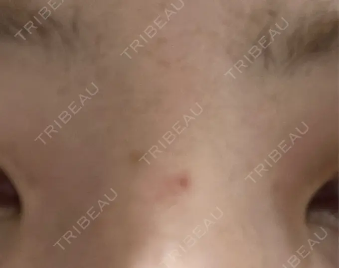 ほくろ・いぼ除去レーザー（肌） Mavie Beauty Clinic （マヴィービューティークリニック） AFTER メイン用