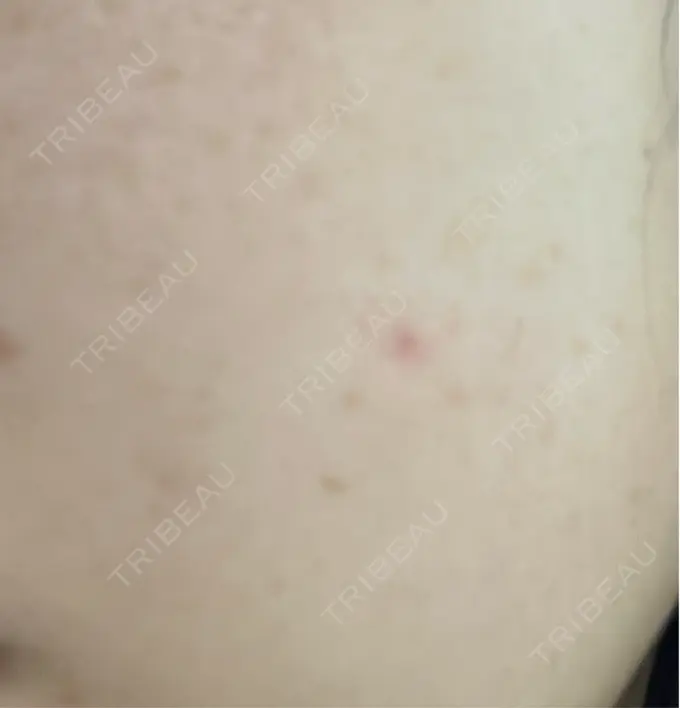 ほくろ・いぼ除去レーザー（肌） Mavie Beauty Clinic （マヴィービューティークリニック） DAY 13 メイン用