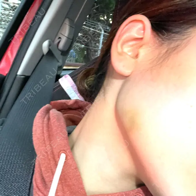 ボトックス（エラ・小顔） TCB東京中央美容外科 大分院 DAY 10 メイン用