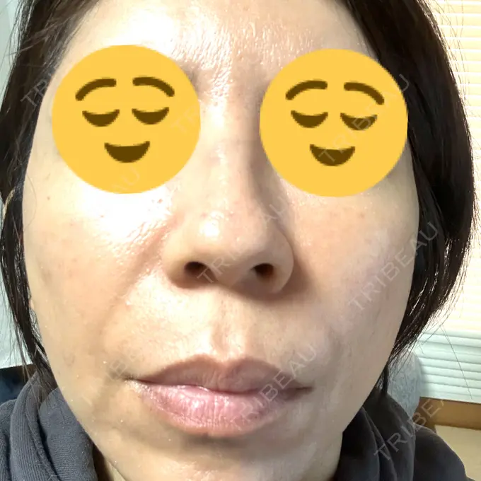 マイクロボトックス ルラ美容クリニック 千葉院 / ルラスキンクリニック 千葉院 DAY 1 メイン用