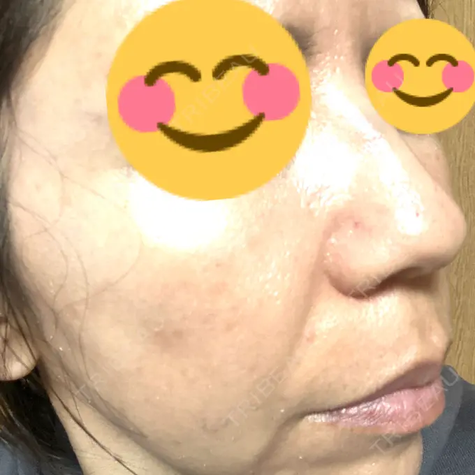 マイクロボトックス ルラ美容クリニック 千葉院 / ルラスキンクリニック 千葉院 DAY 1 メイン用