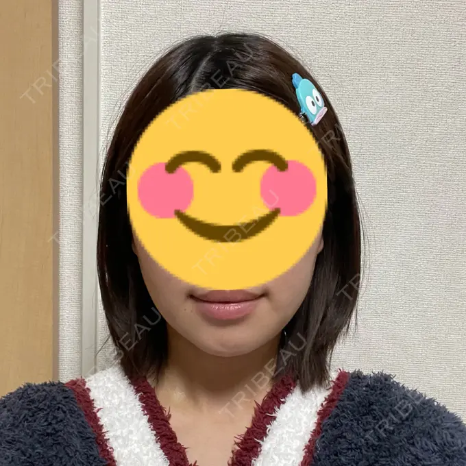 糸リフト / バッカルファット除去 / 脂肪吸引（顔） / ボトックス（エラ・小顔） アリエル美容クリニック 大宮院 DAY 12 メイン用