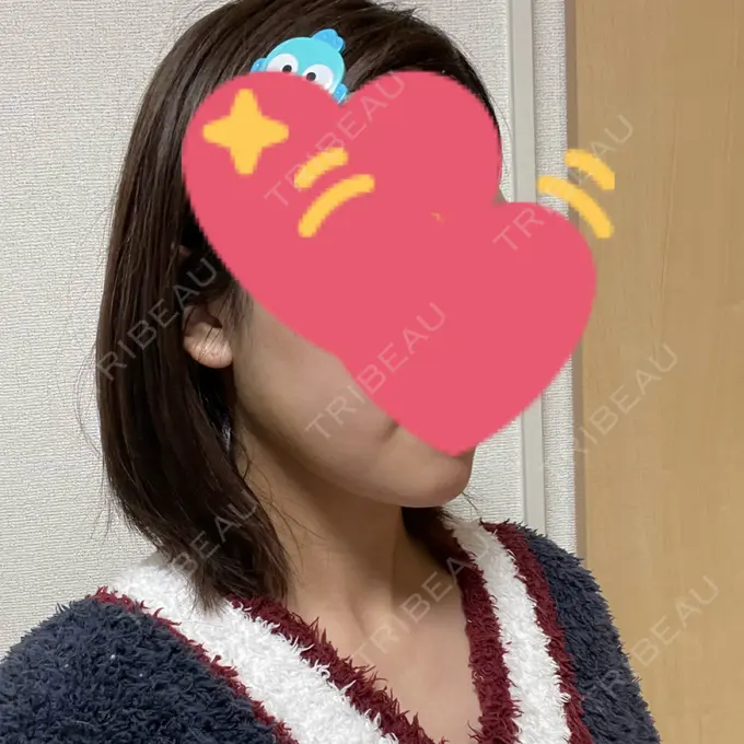 糸リフト / バッカルファット除去 / 脂肪吸引（顔） / ボトックス（エラ・小顔） アリエル美容クリニック 大宮院 DAY 12 メイン用