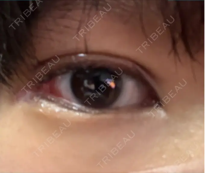 二重埋没 / 鼻尖形成（切開） / 口唇縮小術 / 目尻切開 / タレ目形成・グラマラスライン（切開） / 軟骨移植 / 眉間プロテーゼ アリエル美容クリニック 大宮院 DAY 28 メイン用