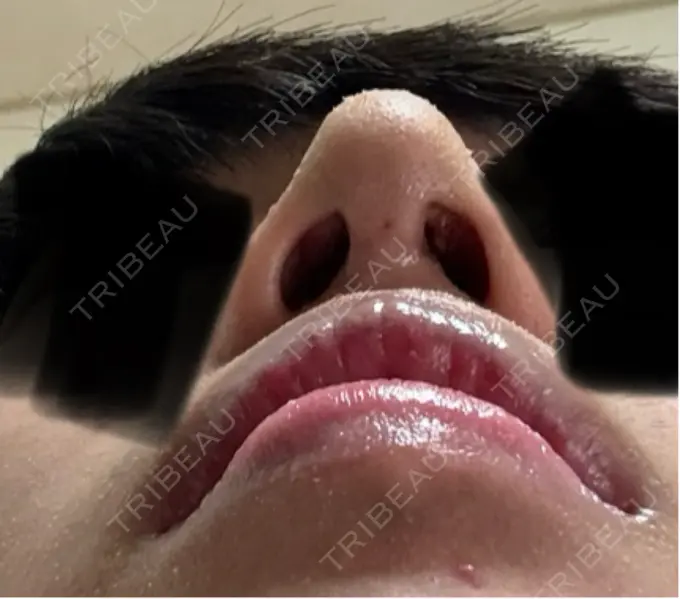 二重埋没 / 鼻尖形成（切開） / 口唇縮小術 / 目尻切開 / タレ目形成・グラマラスライン（切開） / 軟骨移植 / 眉間プロテーゼ アリエル美容クリニック 大宮院 DAY 28 メイン用