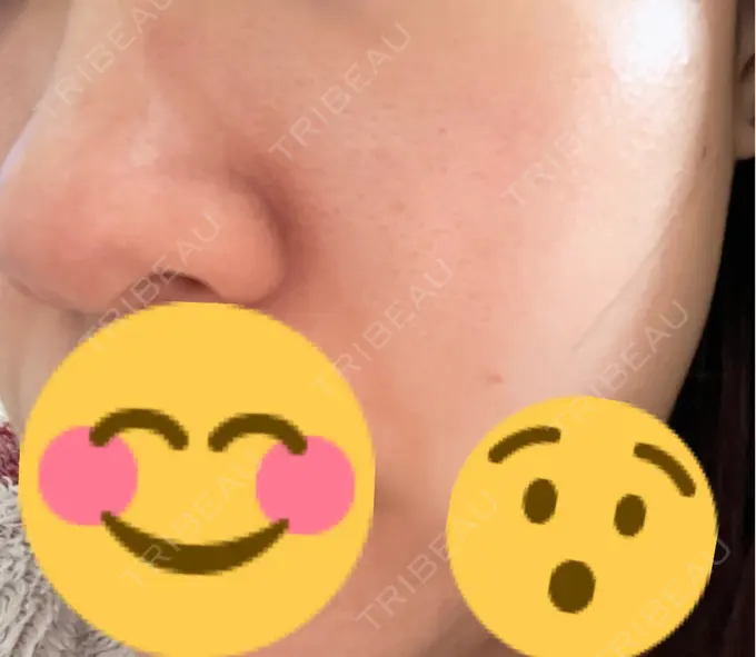 エレクトロポレーション / ヴェルヴェットスキン ミニマムスキンクリニック池袋 AFTER メイン用