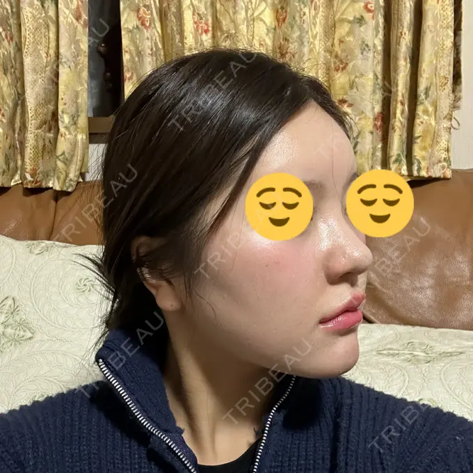 ヒアルロン酸注入（鼻翼基部） THE FIRST CLINIC 町田院 DAY 3 メイン用