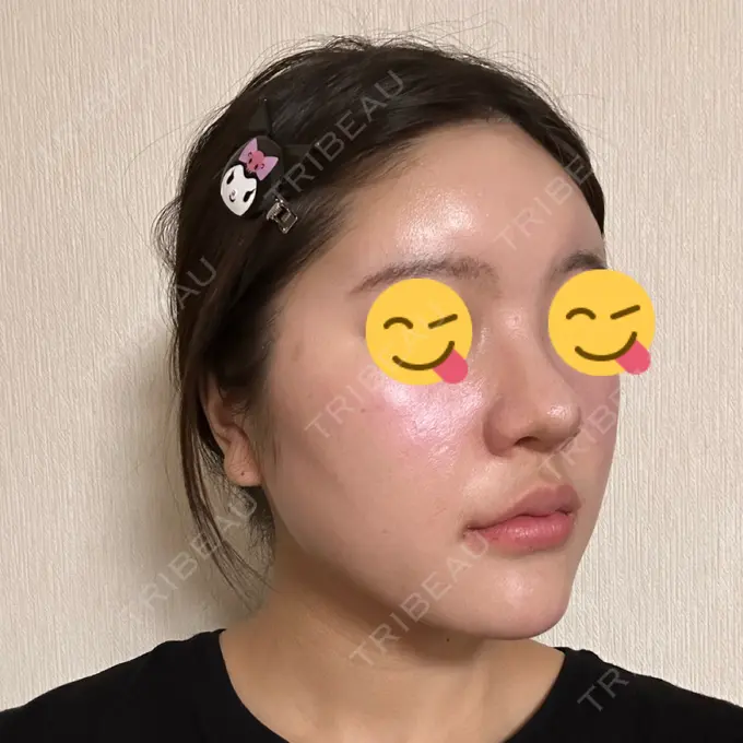 ヒアルロン酸注入（鼻翼基部） THE FIRST CLINIC 町田院 DAY 6 メイン用