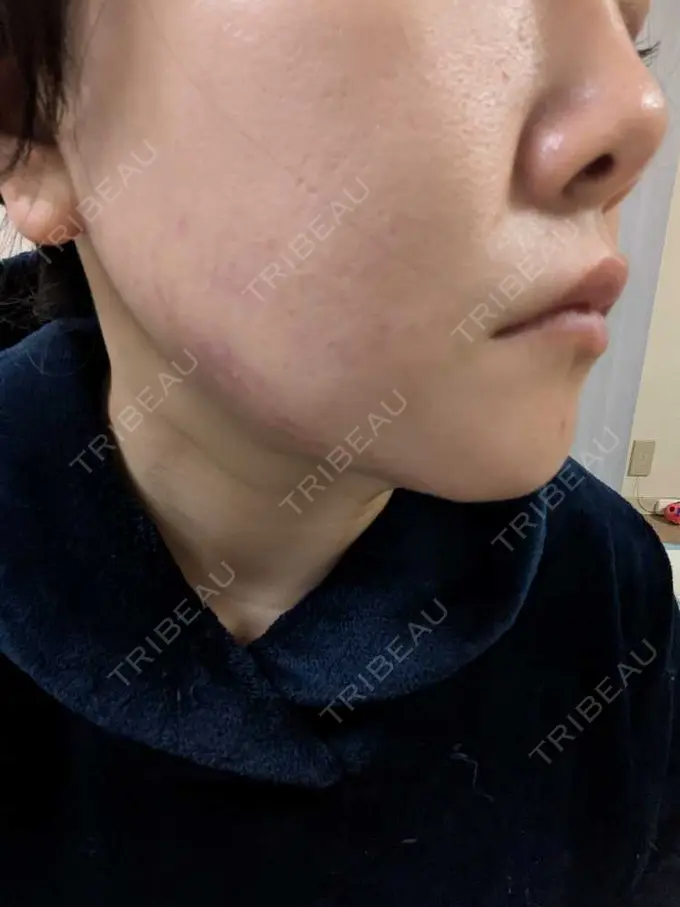 その他（肌） / エレクトロポレーション / サーマクール / RF（高周波）たるみ治療 ゆきスキンクリニック 東池袋 DAY 1 メイン用