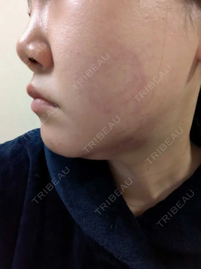 その他（肌） / エレクトロポレーション / サーマクール / RF（高周波）たるみ治療 ゆきスキンクリニック 東池袋 DAY 1 メイン用