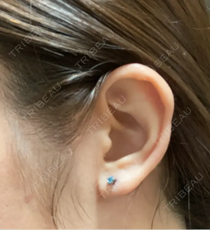 ピアス穴あけ 新宿ラクル美容外科クリニック 新宿院 DAY 1 メイン用