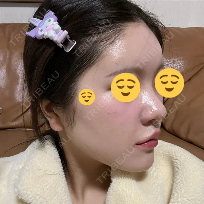 ヒアルロン酸注入（鼻翼基部） THE FIRST CLINIC 町田院 DAY 9 メイン用