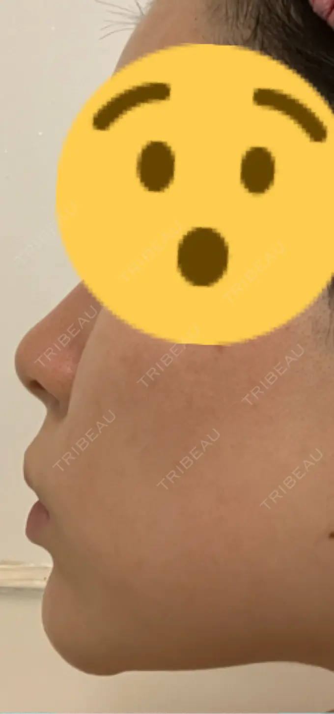 ヒアルロン酸注入（あご） Otus Clinic 【オータスクリニック】 AFTER メイン用