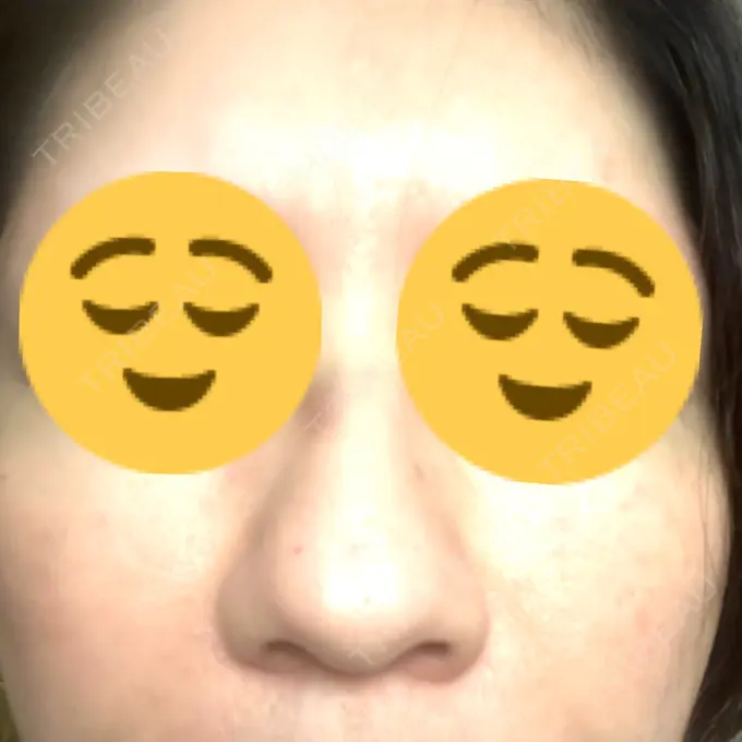 マイクロボトックス ルラ美容クリニック 千葉院 / ルラスキンクリニック 千葉院 DAY 2 メイン用