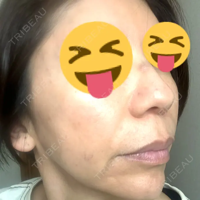 マイクロボトックス ルラ美容クリニック 千葉院 / ルラスキンクリニック 千葉院 DAY 2 メイン用