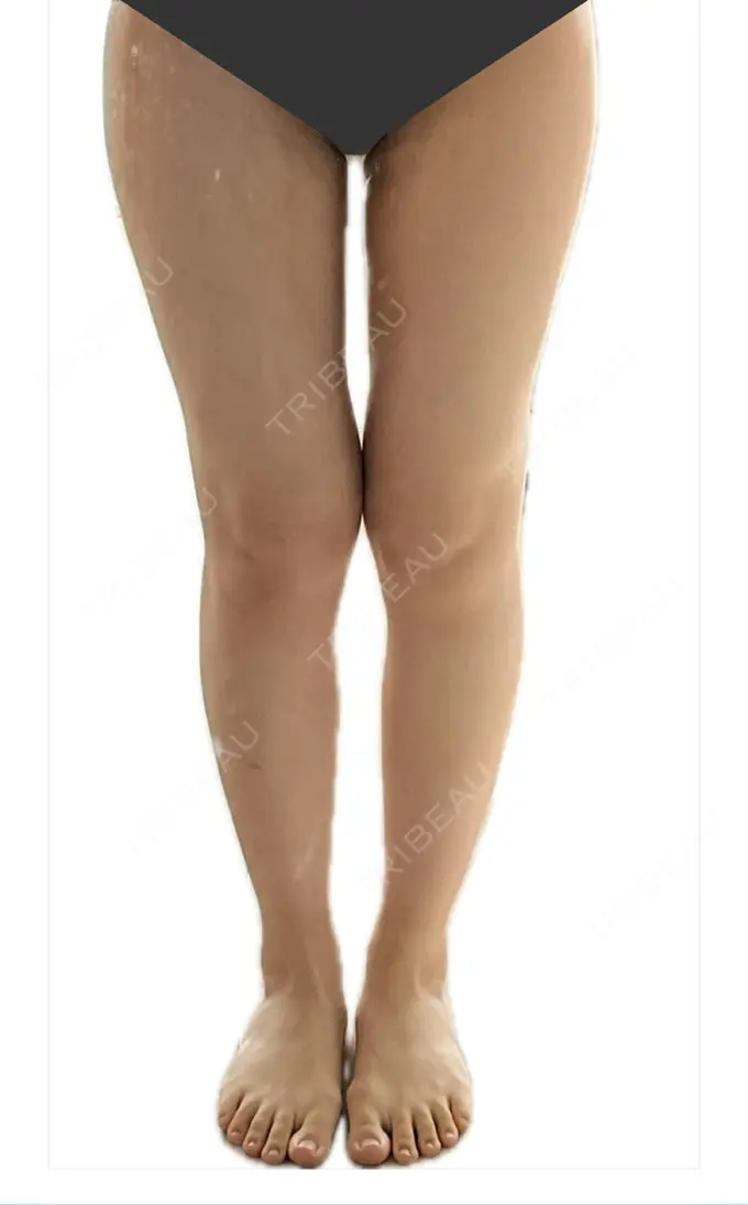 脂肪吸引（脚） Mods Clinic（モッズクリニック） 名古屋院 DAY 125 メイン用