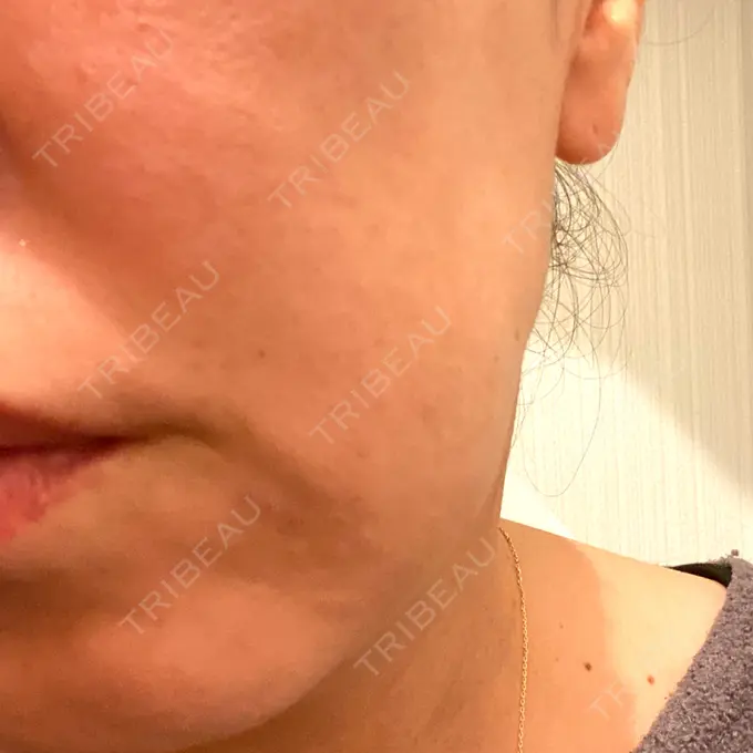 ボトックス（エラ・小顔） TCB東京中央美容外科 神戸院 DAY 35 メイン用