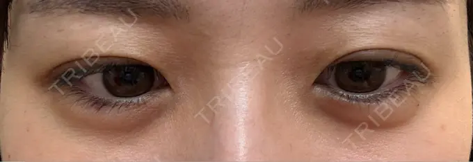 鼻翼基部形成（貴族手術） / ヒアルロン酸注入（涙袋） / ヒアルロン酸注入（あご） / ヒアルロン酸注入（頬） フィラークリニック 大阪梅田院 DAY 0 メイン用