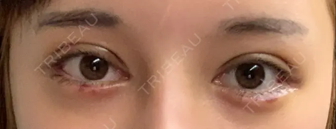 二重切開 / 眼瞼下垂（切開） / 目尻切開 / タレ目形成・グラマラスライン（切開） / ヒアルロン酸注入（涙袋） ジュエリー美容外科 DAY 9 メイン用