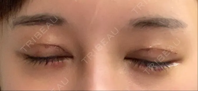 二重切開 / 眼瞼下垂（切開） / 目尻切開 / タレ目形成・グラマラスライン（切開） / ヒアルロン酸注入（涙袋） ジュエリー美容外科 DAY 9 メイン用