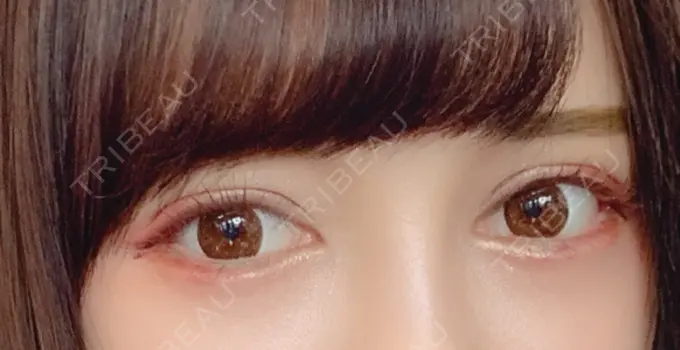 二重切開 / 眼瞼下垂（切開） / 目尻切開 / タレ目形成・グラマラスライン（切開） / ヒアルロン酸注入（涙袋） ジュエリー美容外科 DAY 10 メイン用