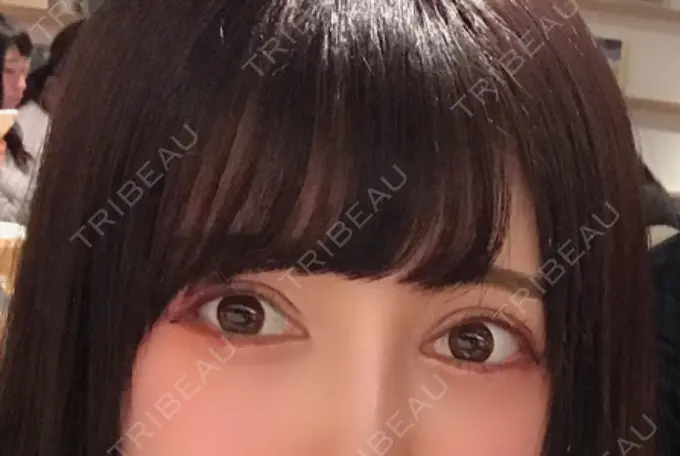 二重切開 / 眼瞼下垂（切開） / 目尻切開 / タレ目形成・グラマラスライン（切開） / ヒアルロン酸注入（涙袋） ジュエリー美容外科 DAY 10 メイン用