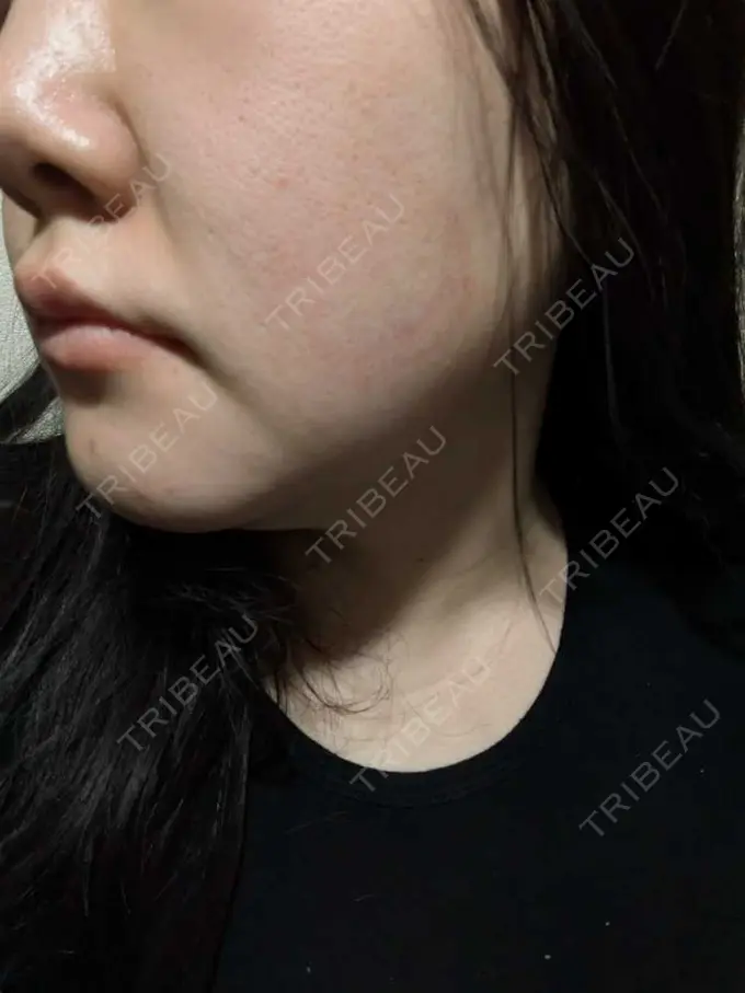 その他（肌） / エレクトロポレーション / サーマクール / RF（高周波）たるみ治療 ゆきスキンクリニック 東池袋 AFTER メイン用