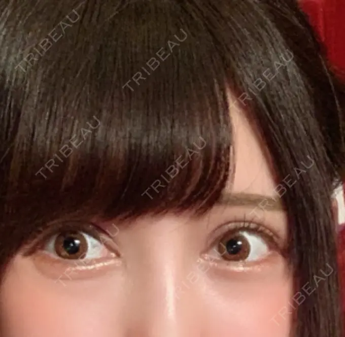 二重切開 / 眼瞼下垂（切開） / 目尻切開 / タレ目形成・グラマラスライン（切開） / ヒアルロン酸注入（涙袋） ジュエリー美容外科 DAY 13 メイン用