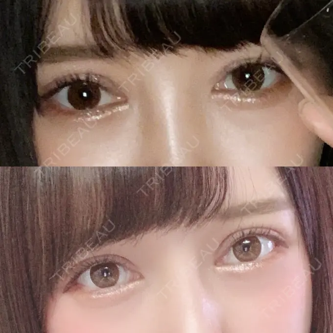 二重切開 / 眼瞼下垂（切開） / 目尻切開 / タレ目形成・グラマラスライン（切開） / ヒアルロン酸注入（涙袋） ジュエリー美容外科 AFTER メイン用