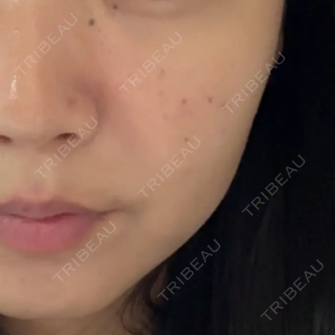 ボトックス（あご） / ボトックス（エラ・小顔） / 脂肪溶解注射（顔） / その他（鼻） Zetith Beauty Clinic 福岡院 AFTER メイン用