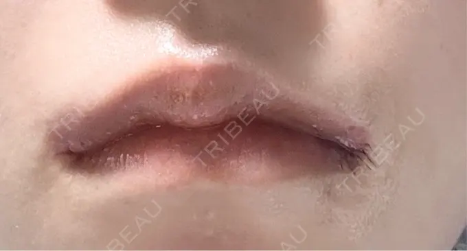 口角挙上 くさのたろうクリニック DAY 233 メイン用