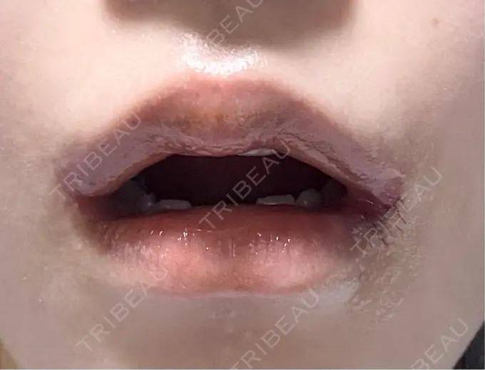 口角挙上 くさのたろうクリニック DAY 233 メイン用