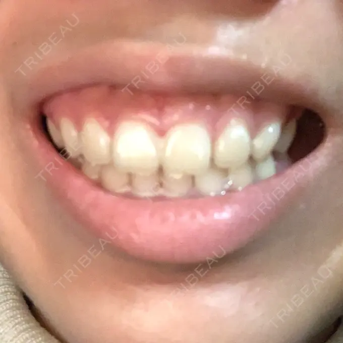 ガミースマイル手術 有楽町美容外科クリニック DAY 0 メイン用