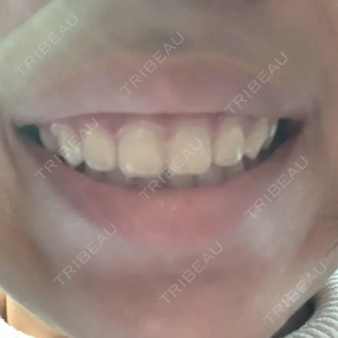 ガミースマイル手術 有楽町美容外科クリニック DAY 0 メイン用