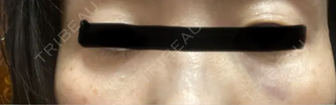 肌ヒアルロン酸注入（たるみ・シワ改善） / シワ取りボトックス / ヒアルロン酸注入（目の下） LE CLINIC DAY 0 メイン用