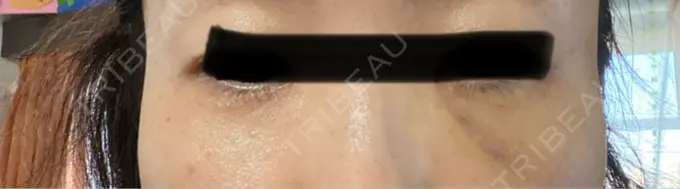 肌ヒアルロン酸注入（たるみ・シワ改善） / シワ取りボトックス / ヒアルロン酸注入（目の下） LE CLINIC DAY 2 メイン用