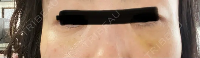 肌ヒアルロン酸注入（たるみ・シワ改善） / シワ取りボトックス / ヒアルロン酸注入（目の下） LE CLINIC DAY 6 メイン用