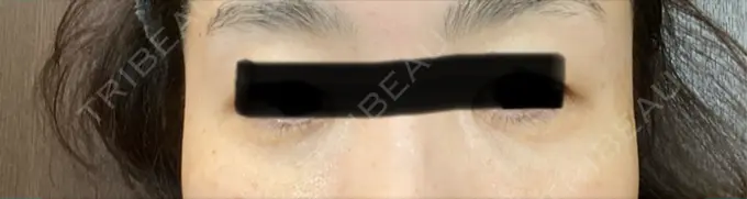 肌ヒアルロン酸注入（たるみ・シワ改善） / シワ取りボトックス / ヒアルロン酸注入（目の下） LE CLINIC AFTER メイン用