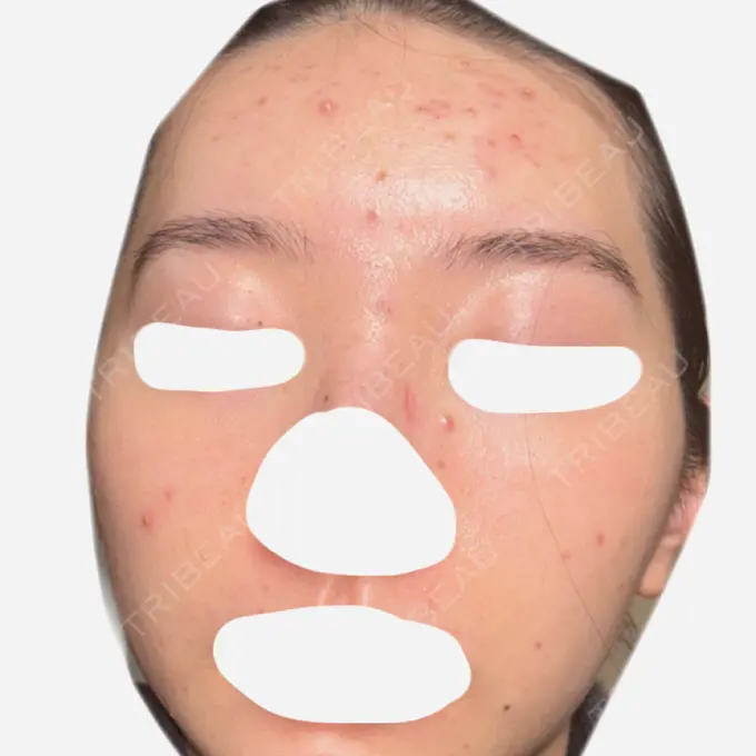 ヴェルヴェットスキン / アグネス 日本ウェルネス再生クリニック DAY 25 メイン用