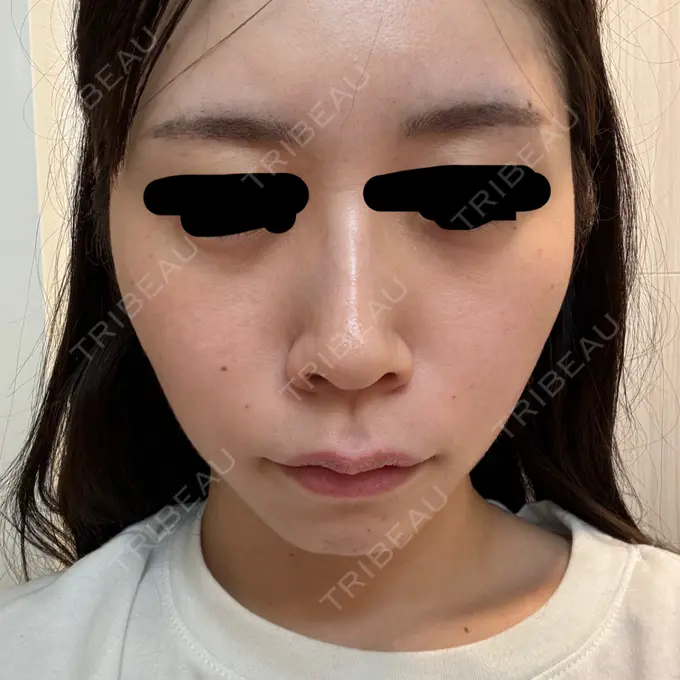 鼻翼基部形成（貴族手術） / ヒアルロン酸注入（涙袋） / ヒアルロン酸注入（あご） / ヒアルロン酸注入（頬） フィラークリニック 大阪梅田院 DAY 0 メイン用