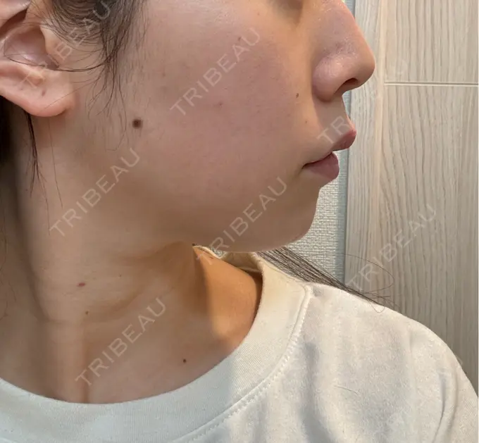 鼻翼基部形成（貴族手術） / ヒアルロン酸注入（涙袋） / ヒアルロン酸注入（あご） / ヒアルロン酸注入（頬） フィラークリニック 大阪梅田院 DAY 0 メイン用